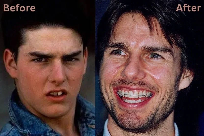 Curious About Tom Cruise Three Front Teeth? Here Is The Real Scoop And Photos Explaining His Unique Dental Situation Over The Years.